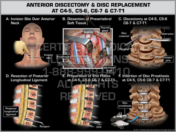 Exhibit of Anterior Discectomy & Disc Replacement at C4-5, C5-6, C6-7 & C7-T1