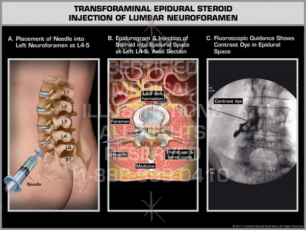 Exhibit of Transforaminal Epidural Steroid Injection of Lumbar Neuroforamen- Print Quality Instant Download