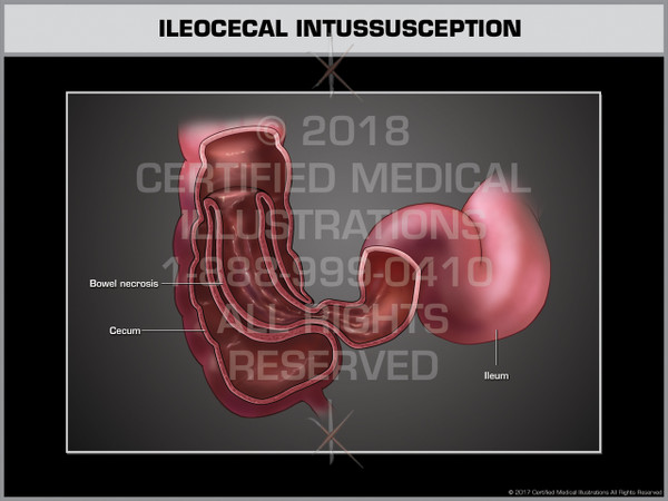 Exhibit of Ileocecal Intussusception