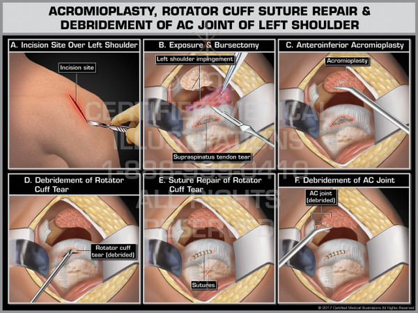 Exhibit of  Acromioplasty, Rotator Cuff Suture Repair & Debridement of AC Joint of Left Shoulder