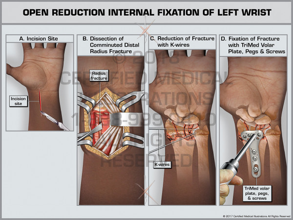 Exhibit of Open Reduction Internal Fixation of Left Wrist