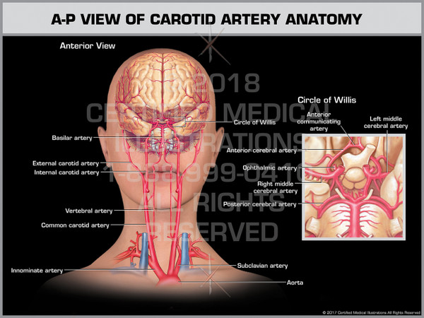 Exhibit of A-P View of Carotid Artery Anatomy