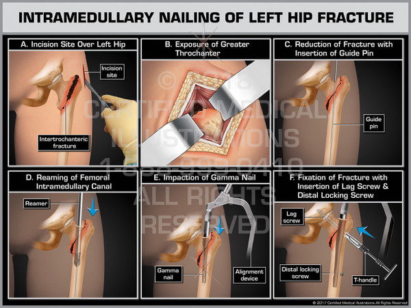 Exhibit of Intramedullary Nailing of Left Hip Fracture