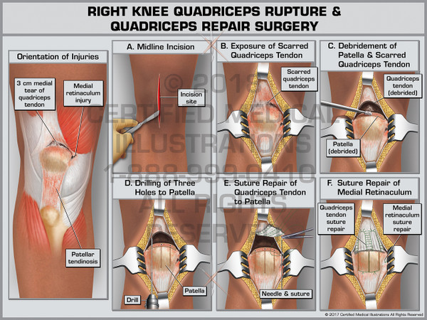 Exhibit of Right Knee Quadriceps Rupture & Quadriceps Repair Surgery