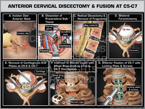 Exhibit of Anterior Cervical Discectomy & Fusion at C5-C7