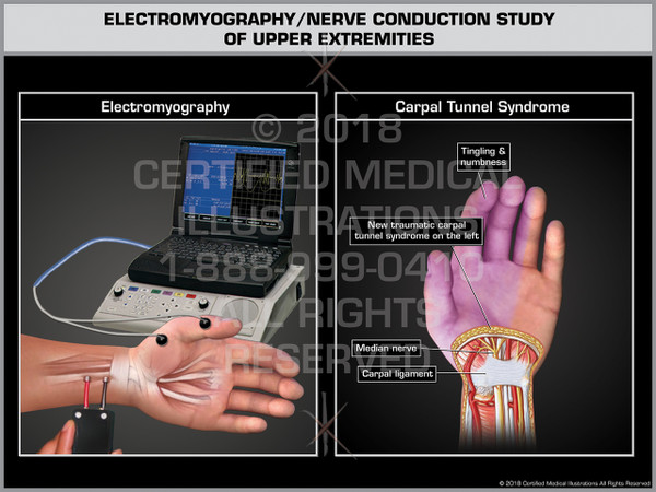 Exhibit of Electromyography/ Nerve Conduction Study of Upper Extremities- Print Quality Instant Download