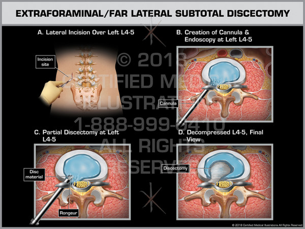 Exhibit of Extraforaminal/ Far Lateral Subtotal Discectomy