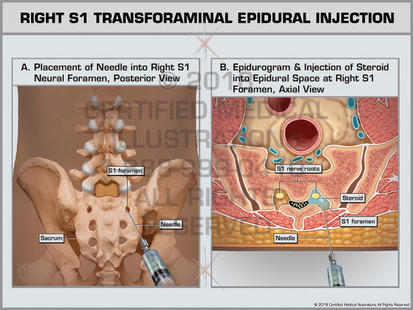 Exhibit of Right S1 Transforaminal Epidural Injection