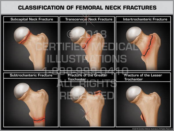 Classification of Femoral Neck Fractures