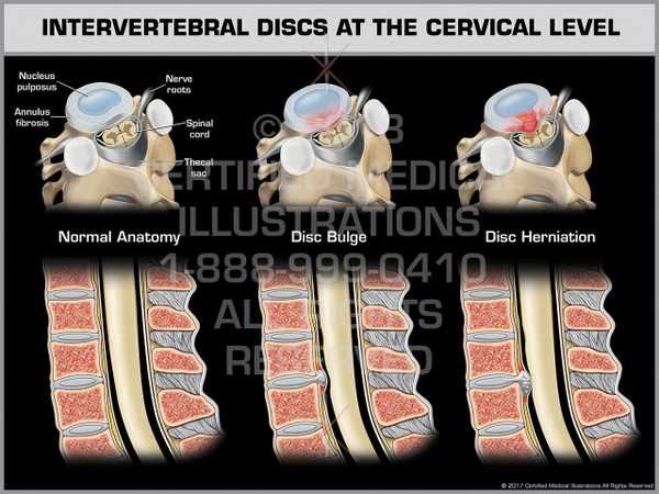 Intervertebral Discs at the Cervical Level