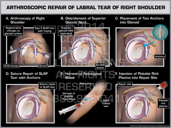 Exhibit of Arthroscopic Repair of Labral Tear of Right Shoulder.
