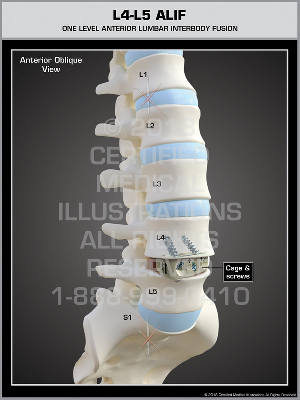 L4-L5 ALIF (Anterior-Lumbar Stabilization System) 
