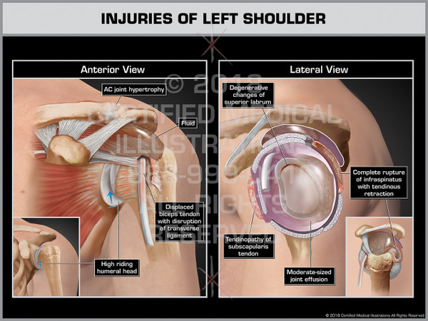 Injuries of Left Shoulder