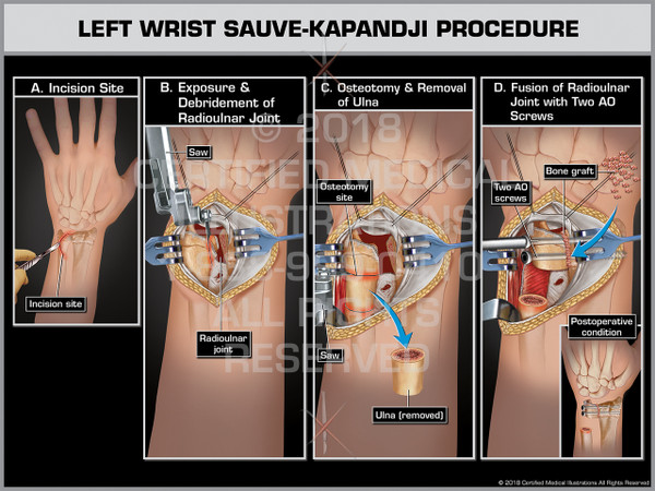 Left Wrist Sauve-Kapandji Procedure