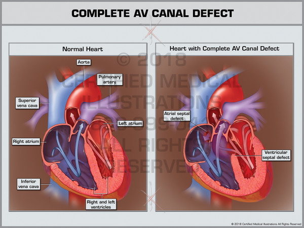 Complete AV Canal Defect