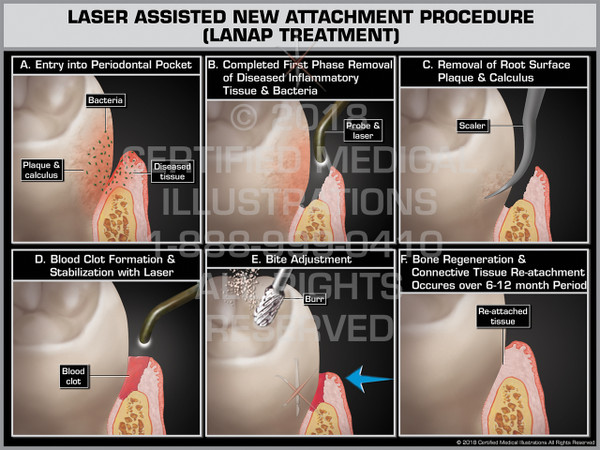 Laser Assisted New Attachment Procedure (LANAP Treatment)
