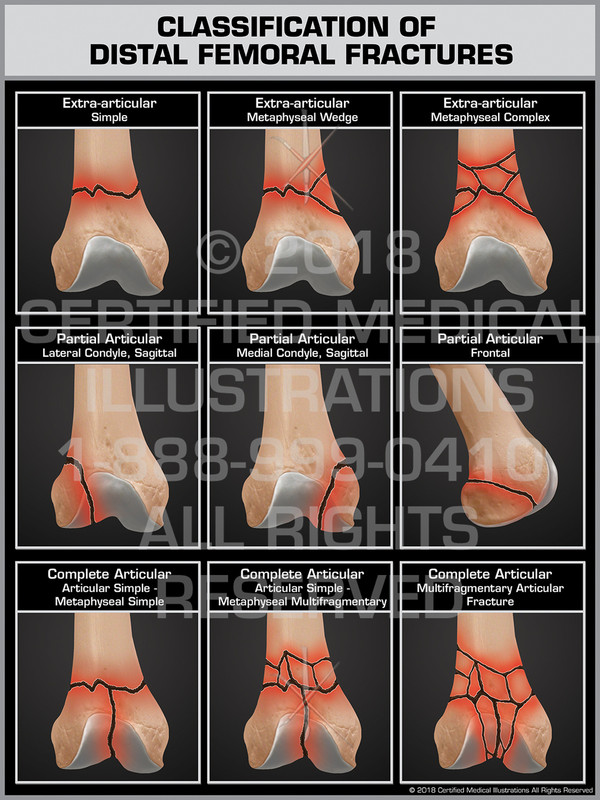 Classification of Distal Femoral Fractures