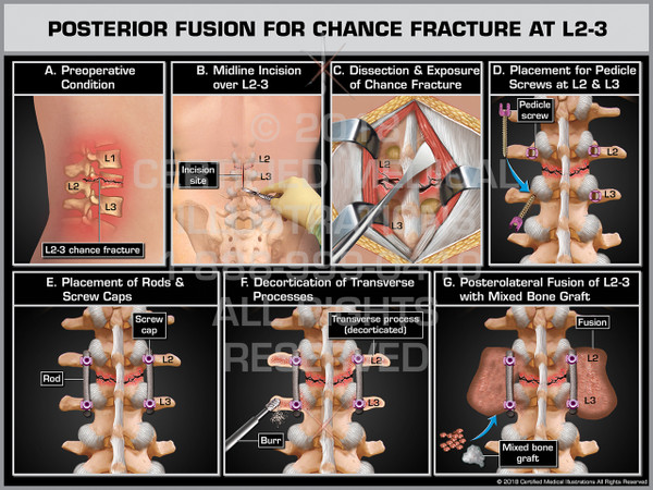 Posterior Fusion for Chance Fracture at L2-3
