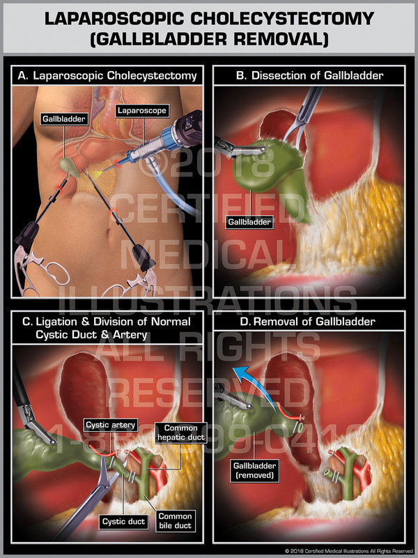 Laparoscopic Cholecystectomy (Gallbladder Removal)