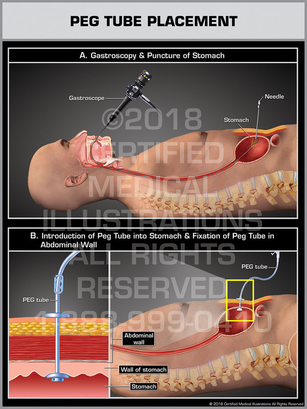 PEG Tube Placement (Percutaneous Endoscopic Gastrostomy)