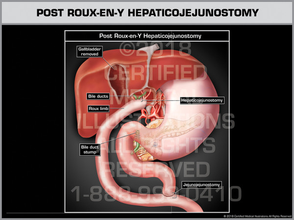 Post Roux-en-Y Hepaticojejunostomy - Print Quality Instant Download
