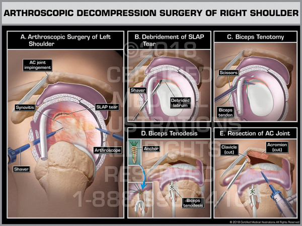 Arthroscopic Decompression Surgery of Right Shoulder - Print Quality Instant Download