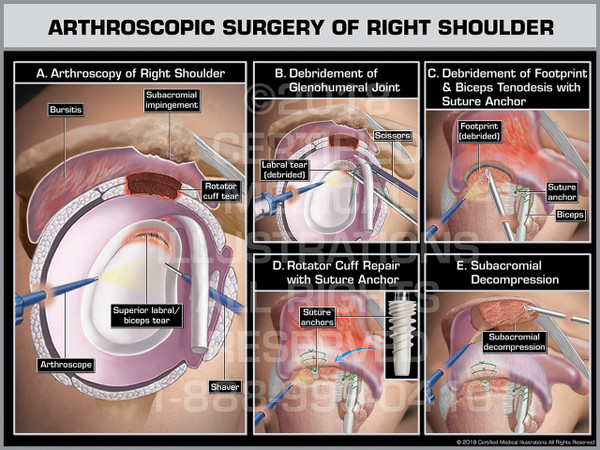 Arthroscopic Surgery of the Right Shoulder - Print Quality Instant Download