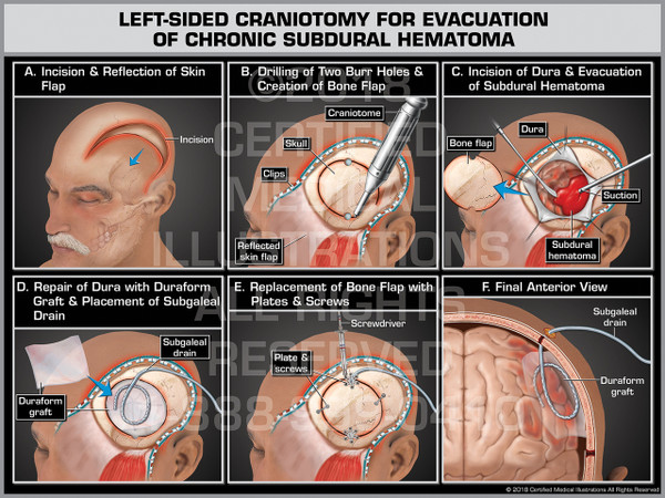 Left-Sided Craniotomy for Evacuation of Chronic Subdural Hematoma