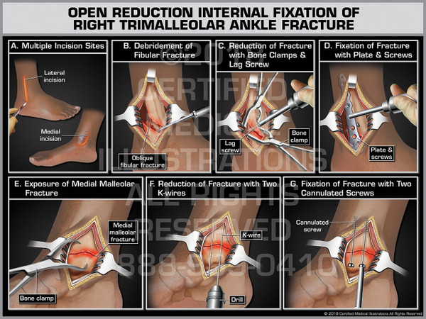 Open Reduction Internal Fixation of Right Trimalleolar Ankle Fracture