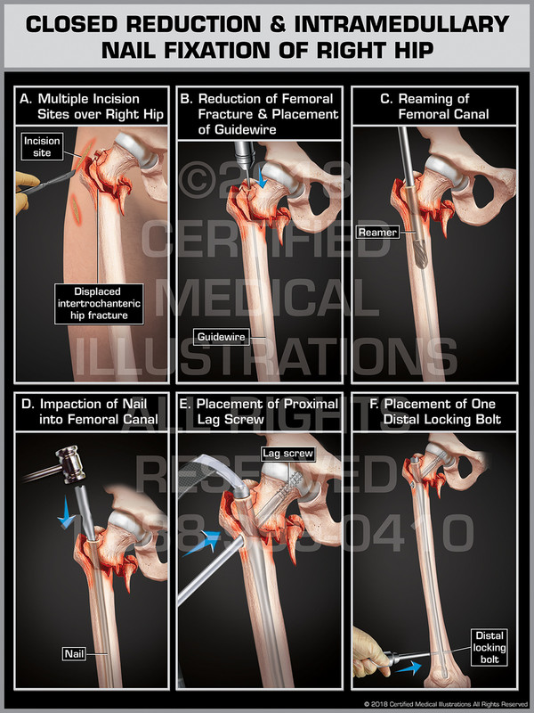 Closed Reduction & Intramedullary Nail Fixation of Right Hip