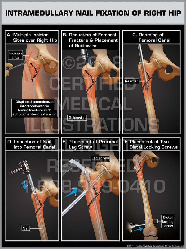 Intramedullary Nail Fixation of Right Hip - Print Quality Instant Download