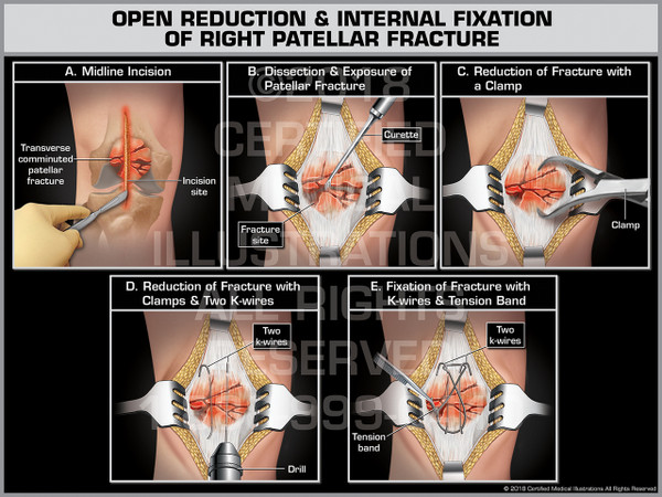 Open Reduction Internal Fixation of Right Patellar Fracture