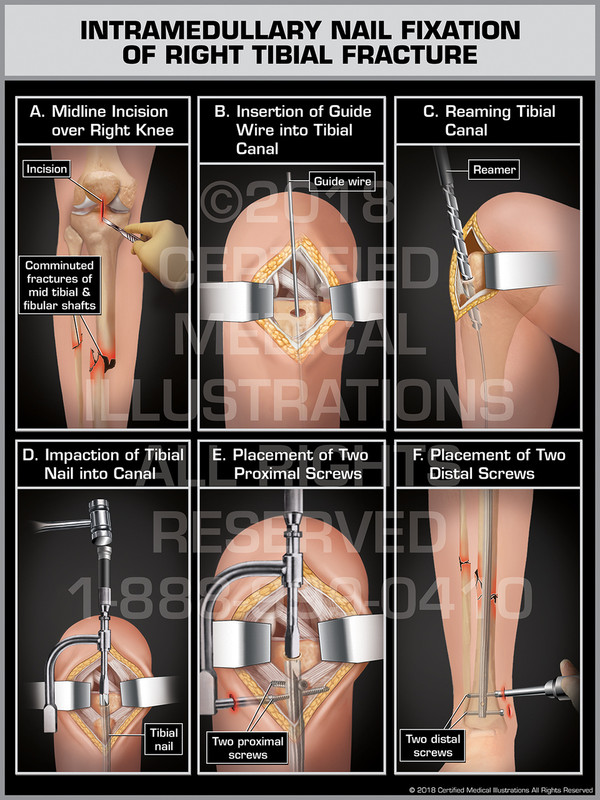 Intramedullary Nail Fixation of Right Tibial Fracture - Print Quality Instant Download