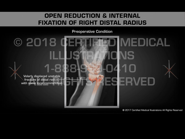Open Reduction & Internal Fixation of Right Distal Radius - Medical Animation