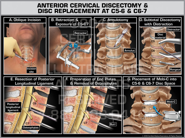 Anterior Cervical Discectomy & Disc Replacement at C5-6 & C6-7 - Print Quality Instant Download