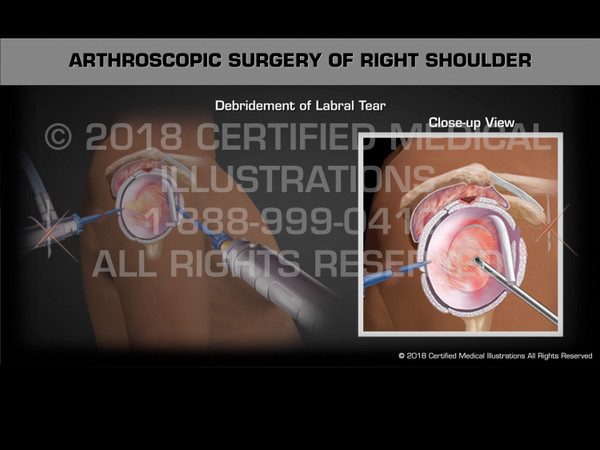 Arthroscopic Surgery of Right Shoulder - Animation