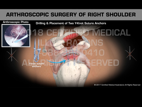Arthroscopic Surgery of Right Shoulder - Medical Animation