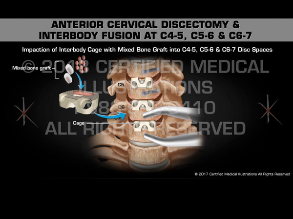 Anterior Cervical Discectomy & Interbody Fusion at C4-5, C5-6 & C6-7 - Medical Animation