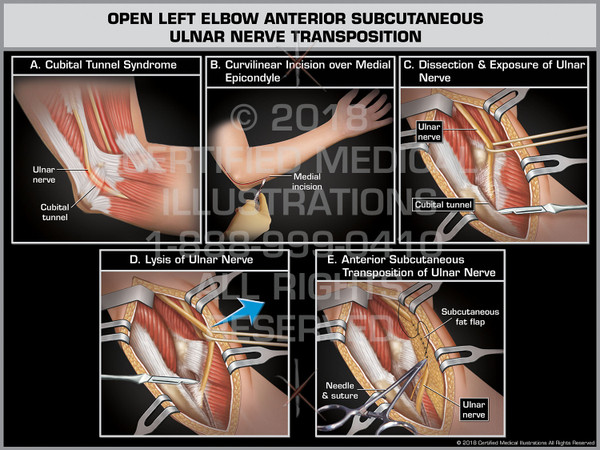 The exhibit illustrates the open left elbow anterior subcutaneous ulnar nerve transposition. The medial elbow is dissected and pulled open with forceps that exposes the subcutaneous fat flap and ulnar nerve, which is lysed of scar tissue. The nerve is transposed anteriorly and stitched into the subcutaneous fat flap lining the arm.
