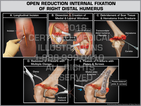 The exhibit illustrates the open reduction internal fixation of the right arm.  The elbow is incised and dissected to expose both medial & lateral windows. The scar tissue hematoma is debrided. The fracture is repaired by realigning the bone and attaching plates and screws.