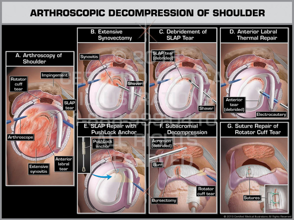 The exhibit illustrates the arthroscopic decompression of the shoulder by performing an extensive synovectomy and the debridement of the SLAP tear. The anterior labral is repaired with a PushLock Anchor, a subacromial decompression is performed and finally the rotator cuff is repaired with sutures.