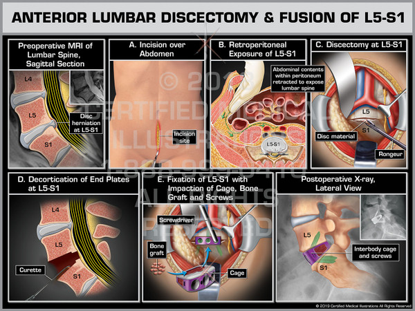 The exhibit illustrates an anterior lumbar discectomy and fusion of the L5-S1 level. The preoperative MRI depicts the disc herniation impinging the thecal sac. The surgery is started with the incision over the abdomen. The abdominal contents within the peritoneum are retracted to expose the lumbar spine. The L5-S1 is incised and followed by a discectomy to remove all disc material. The end plates are decorticated with a curette. Fixation of L5-S1is completed with the impaction of cage, bone graft and screws. Finally the postoperative x-rays show the surgical hardware from the lateral view.
