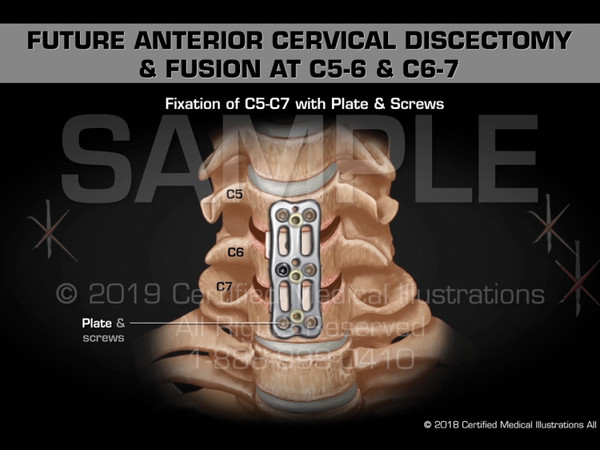 This animation depicts a future anterior cervical discectomy and fusion at C5-6 & C6-7 with the alternative option of a future disc replacement surgery. The surgical steps include the following; transverse incision, dissection of prevertebral soft tissue, retraction and exposure of C5-6 & C6-7, placement of caspar pins at C5, C6 & C7, removal of anterior osteophytes, annulotomy, discectomy, preparation of end plates, bilateral foraminotomies, placement of cages with mixed bone graft into C5-6 & C6-7 disc spaces, fixation of C5-C7 with plate & screws, placement of artificial disc into C5-6 & C6-7 disc spaces.