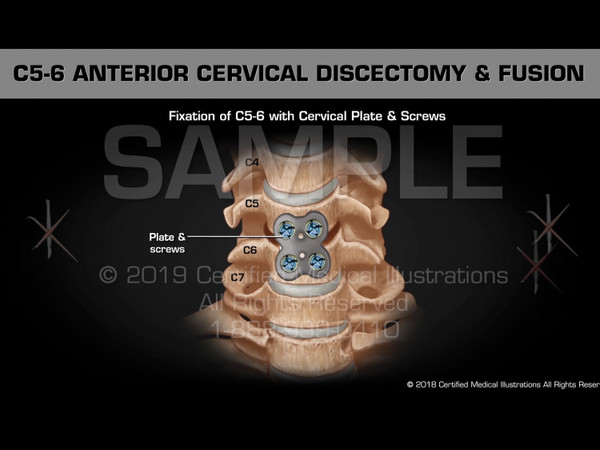 This animation depicts an anterior cervical discectomy and fusion at C5-6. The surgical steps include the following; transverse incision, dissection of prevertebral soft tissue, retraction and exposure of C5-6, preoperative MRI of cervical spine, C5-6 axial section, anterior annulotomy, discectomy, bilateral foraminotomies, preparation of end plates, impaction of structural allograft with mixed bone graft into C5-6 disc space, fixation of C5-6 with plate & screws, postoperative x-ray of cervical spine.