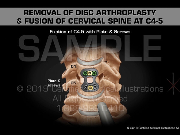 This animation depicts a removal of disc arthroplasty and fusion of cervical spine at C4-5. The surgical steps include the following; incision over anterior neck, dissection of prevertebral soft tissue, retraction and exposure of C4-5, removal of failed prosthesis from C4-5, preparation of end plates, placement of interbody graft with mixed graft into C4-5 disc space, fixation of C4-5 with plate & screws, postoperative x-ray depicting surgical hardware.
