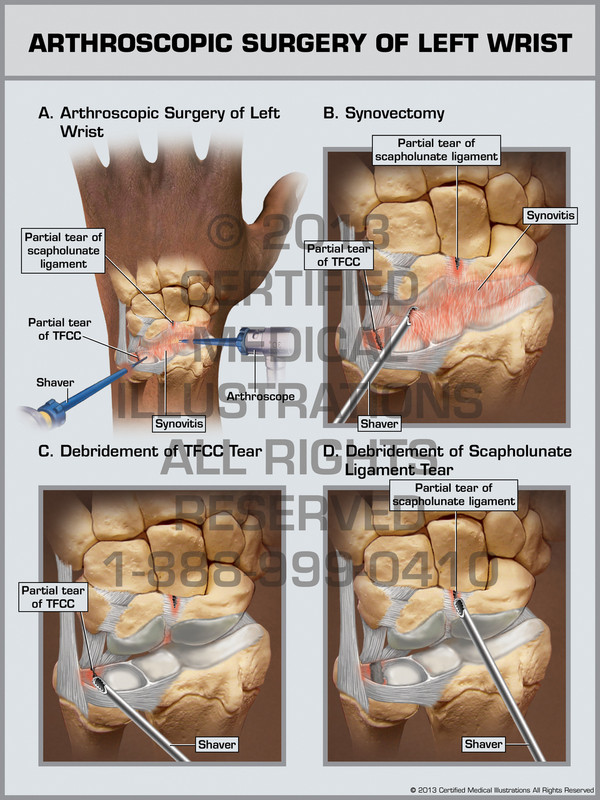 Exhibit of Arthroscopic Surgery of Left Wrist.