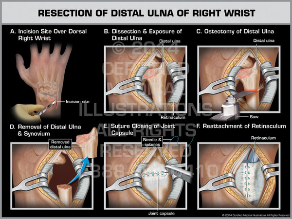 Exhibit of Resection of Distal Ulna of Right Wrist.
