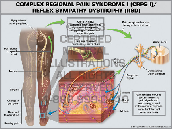 Exhibit of Complex Regional Pain Syndrome I (CRPS I)/ Reflex Sympathy Dystrophy (RSD).