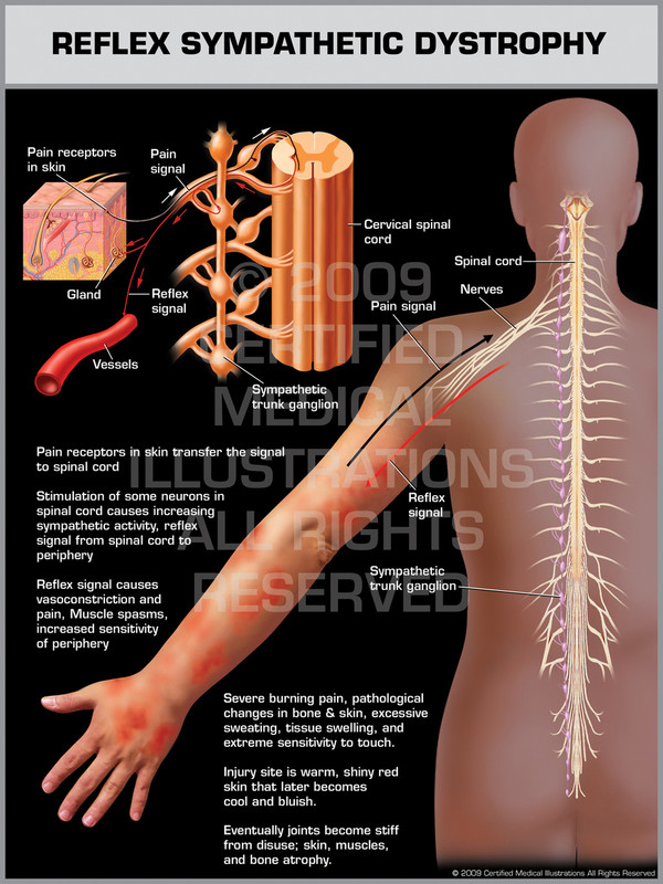 Exhibit of Reflex Sympathetic Dystrophy Upper Limb.