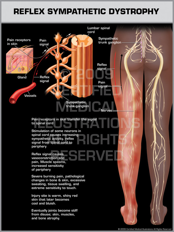 Exhibit of Reflex Sympathetic Dystrophy Lower Limb.